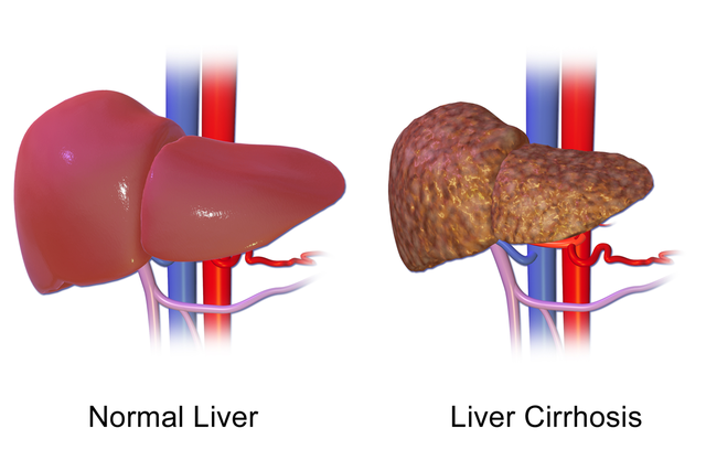 Comparison of Normal Liver and Liver Cirrhosis